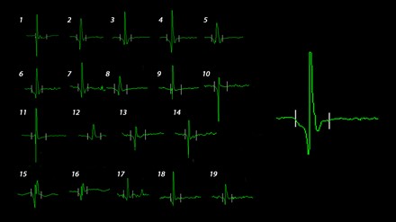 Схема произвольно набранных 20 потенциалов двигательных единиц в стандартной точке мышцы