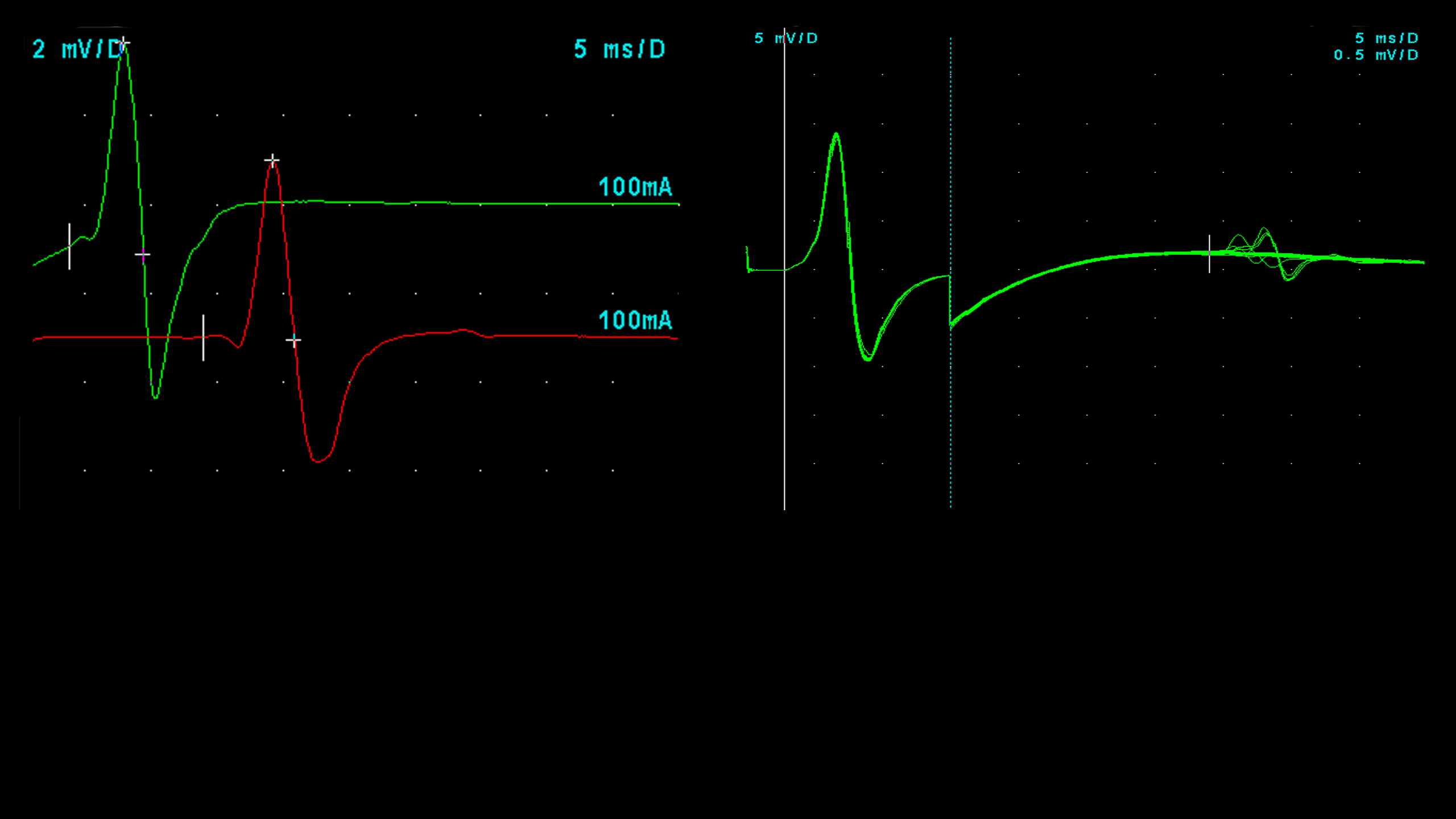 Стимуляционная ЭМГ большеберцового нерва + F-волна